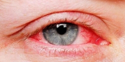 Mùa mưa bão, chủ động phòng bệnh đau mắt đỏ