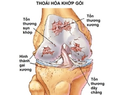 THOÁI HÓA KHỚP GỐI - HIỂU ĐÚNG ĐỂ PHÒNG NGỪA VÀ ĐIỀU TRỊ HIỆU QUẢ